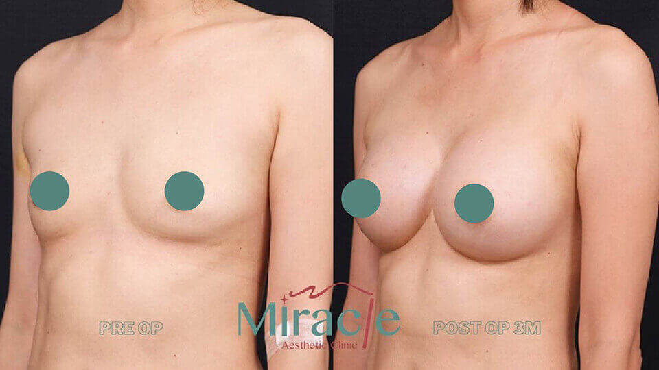 breast-augmentation-intro-case-2
