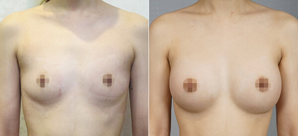 breast-augmentation-intro-case-3