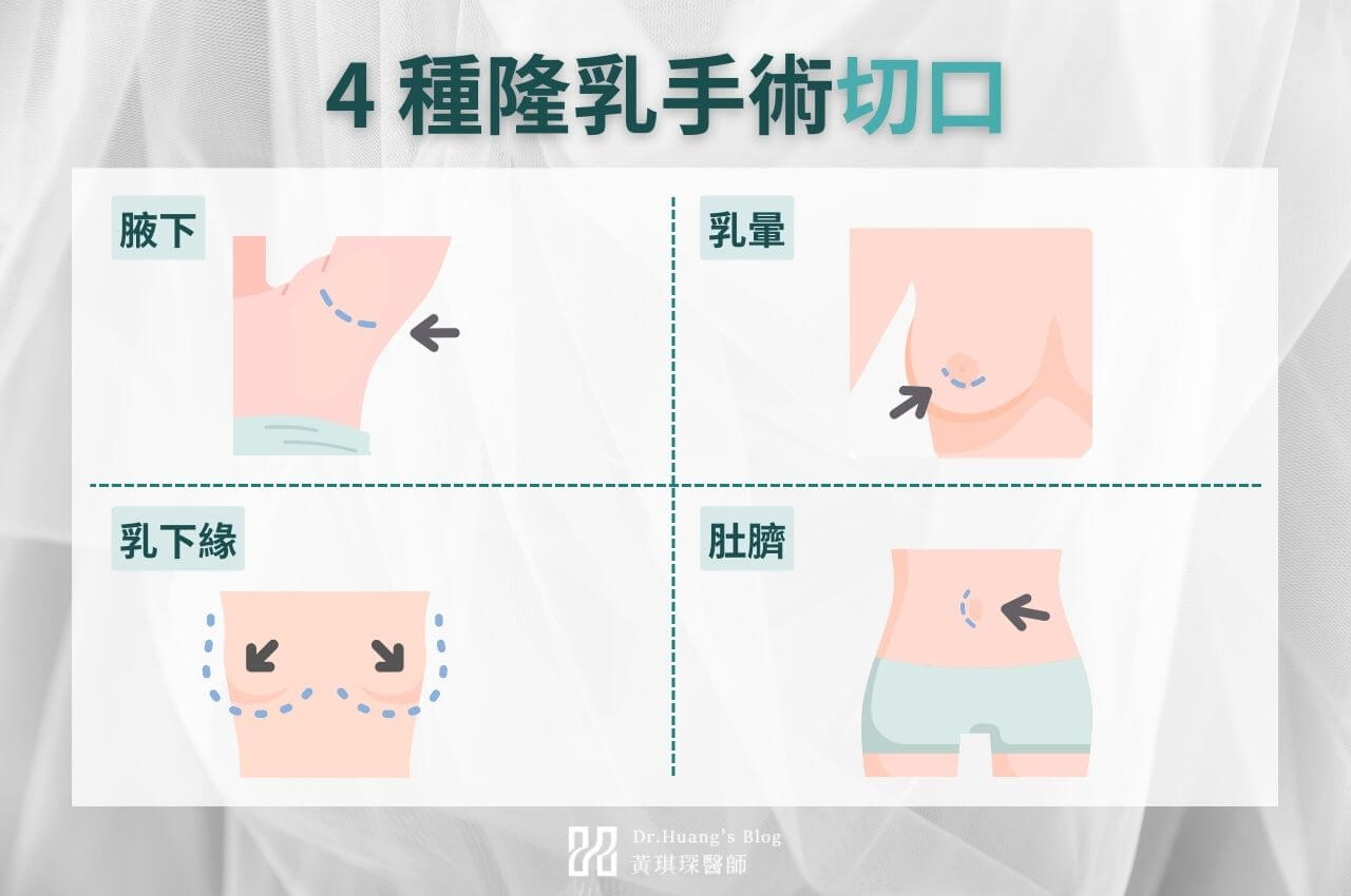 4種隆乳手術切口